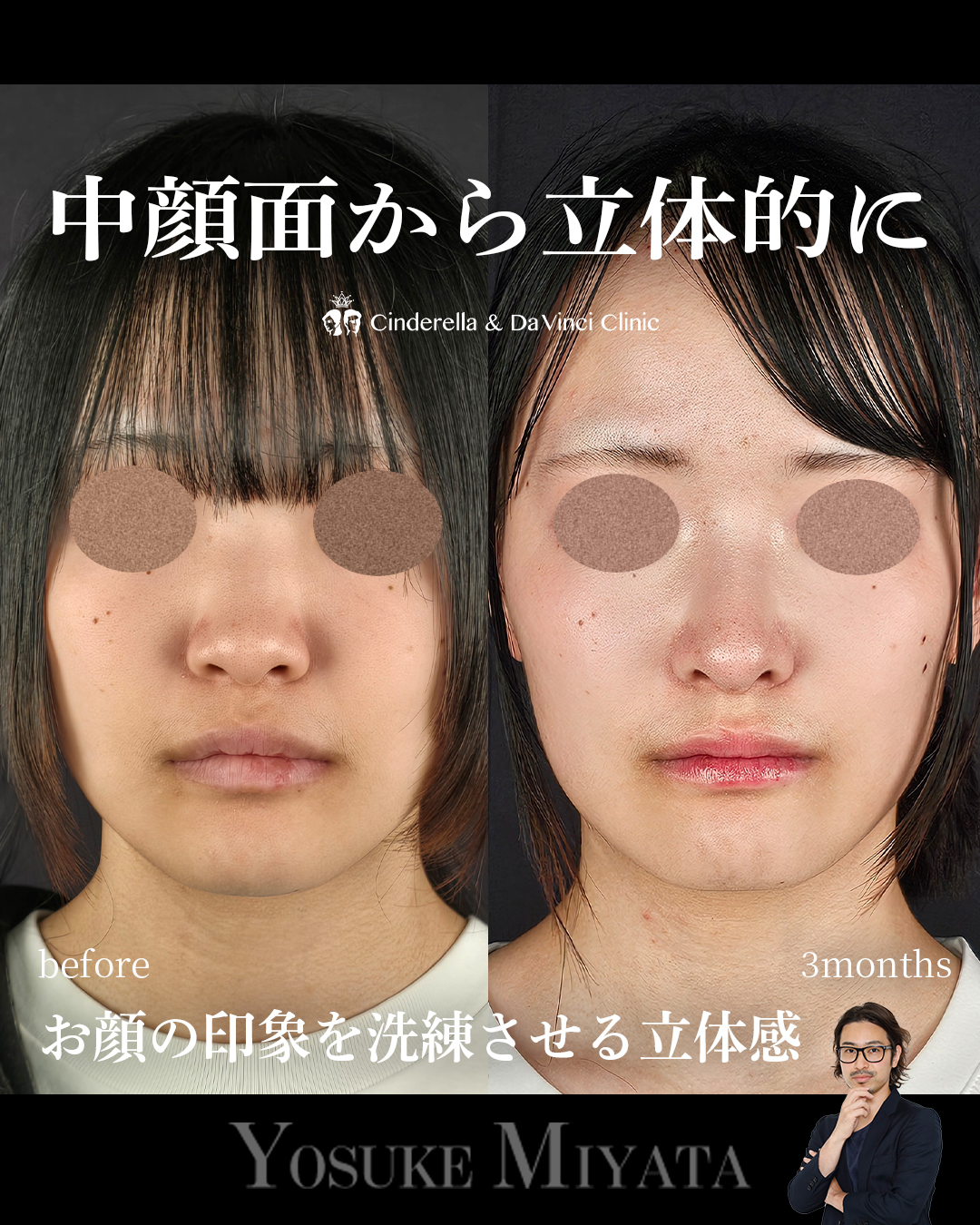 横顔に立体感を出すの画像