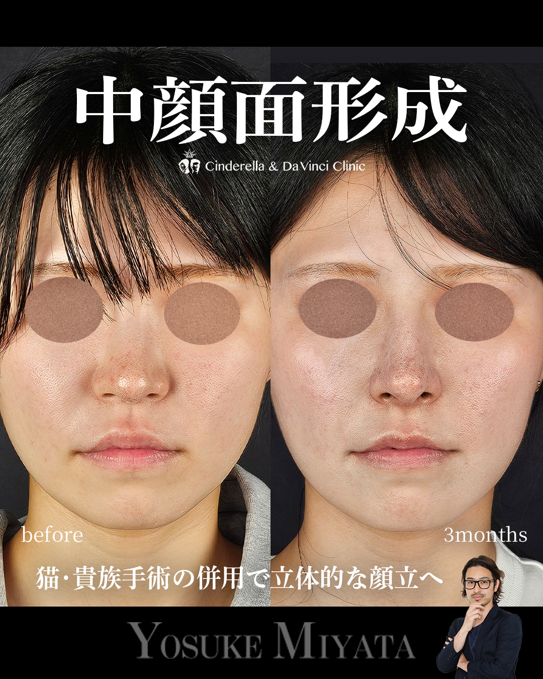 中顔面形成の画像