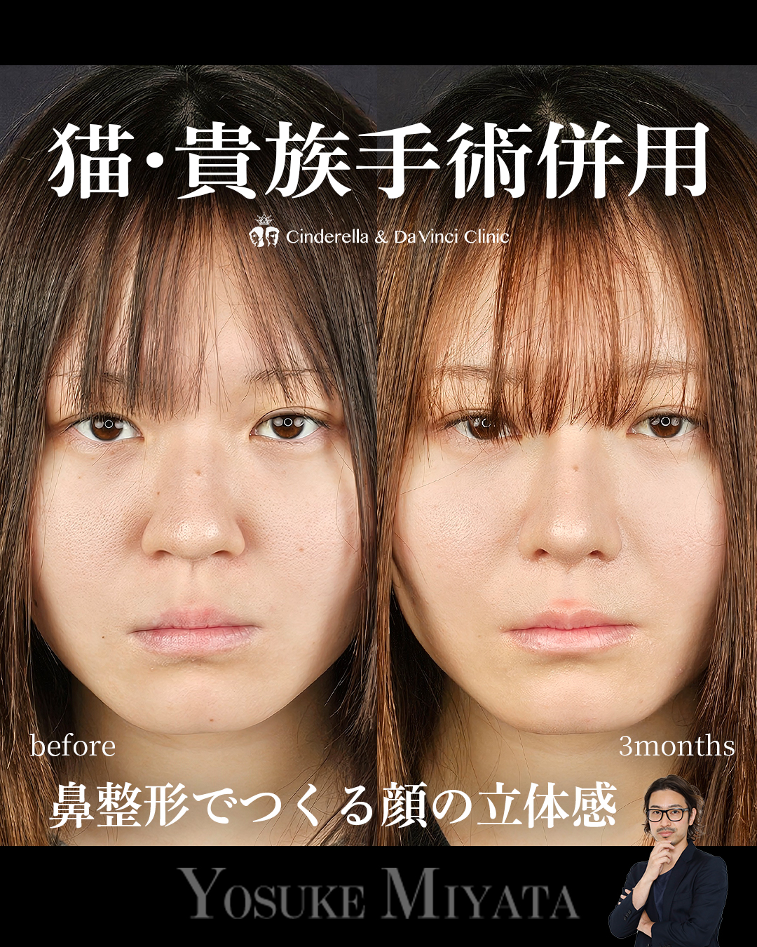 鼻整形のみで垢抜けの画像