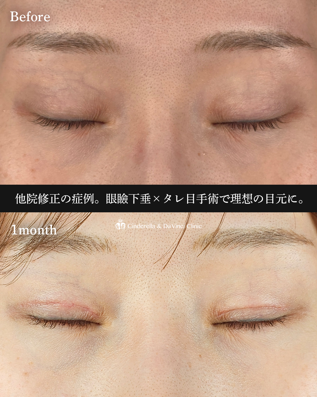 目元の他院修正の画像