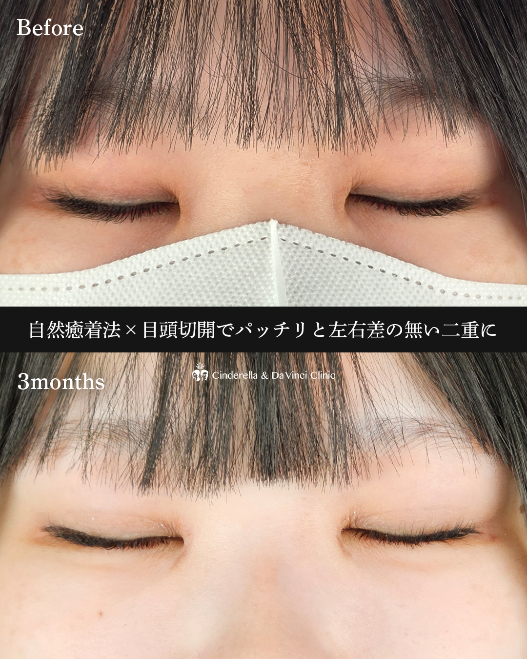 埋没×目頭の画像