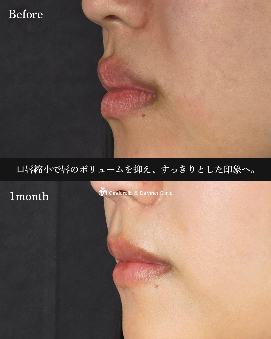 口唇縮小の画像
