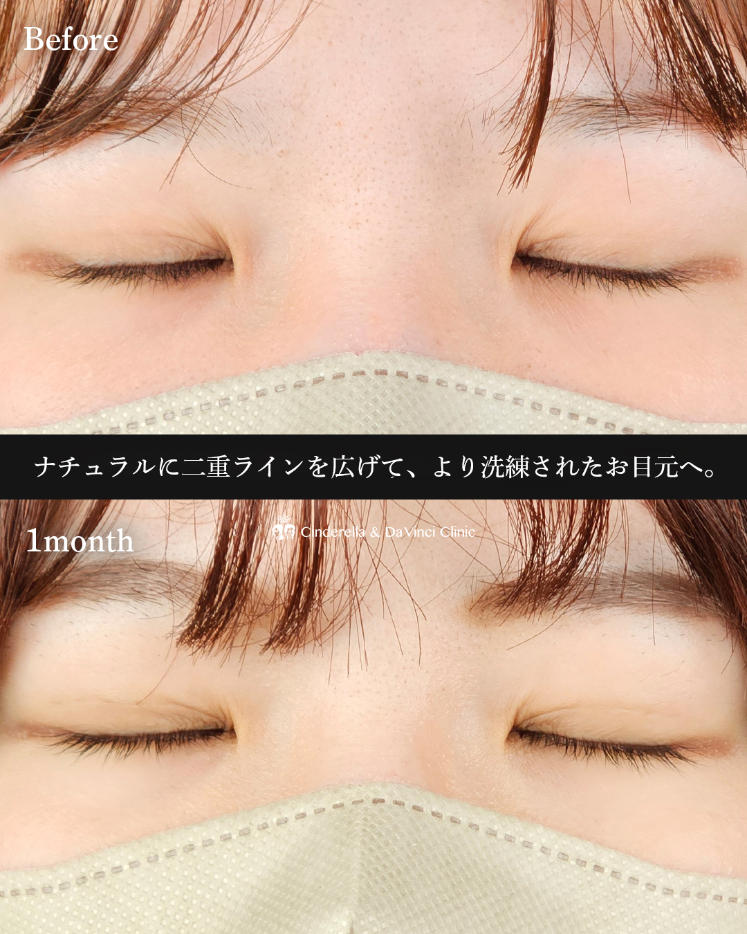 ナチュラル埋没の画像