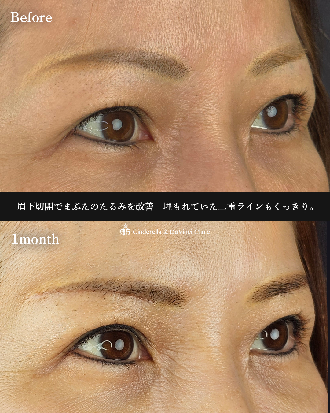 眉下切開でたるみ切除の画像