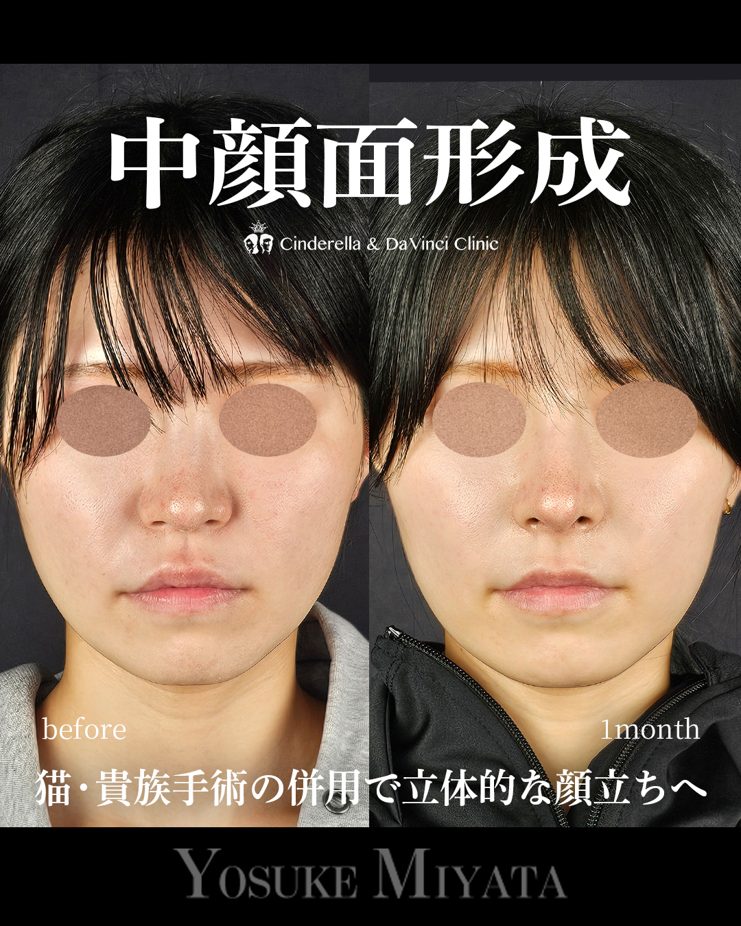 中顔面形成の画像