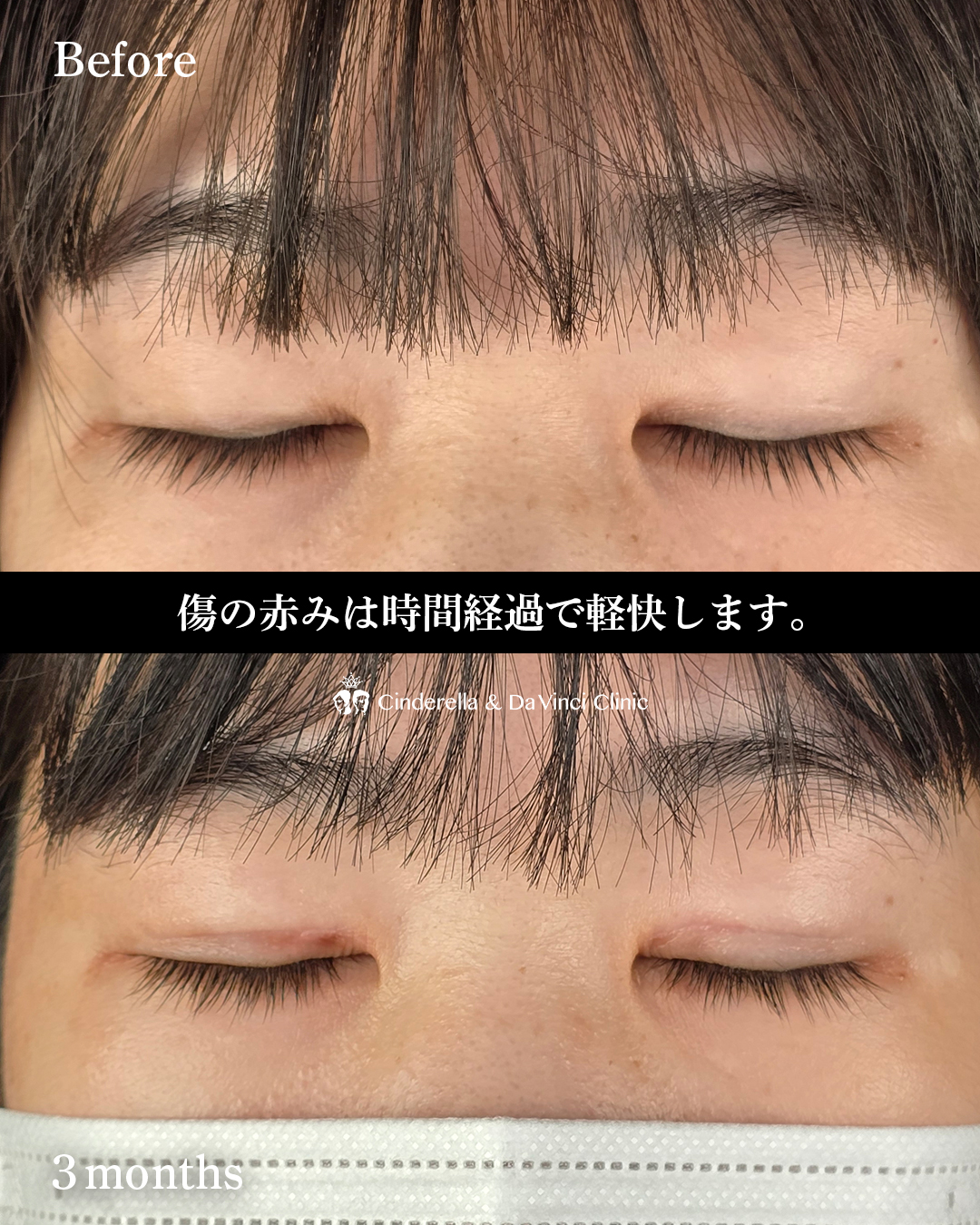 ナチュラルな全切開の画像