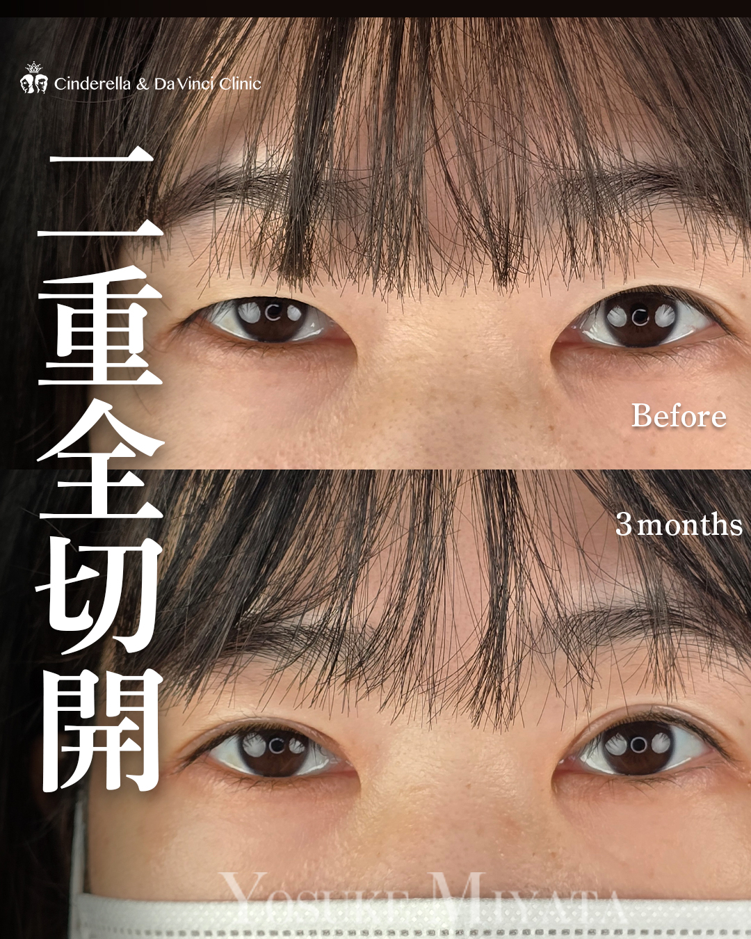 ナチュラルな全切開