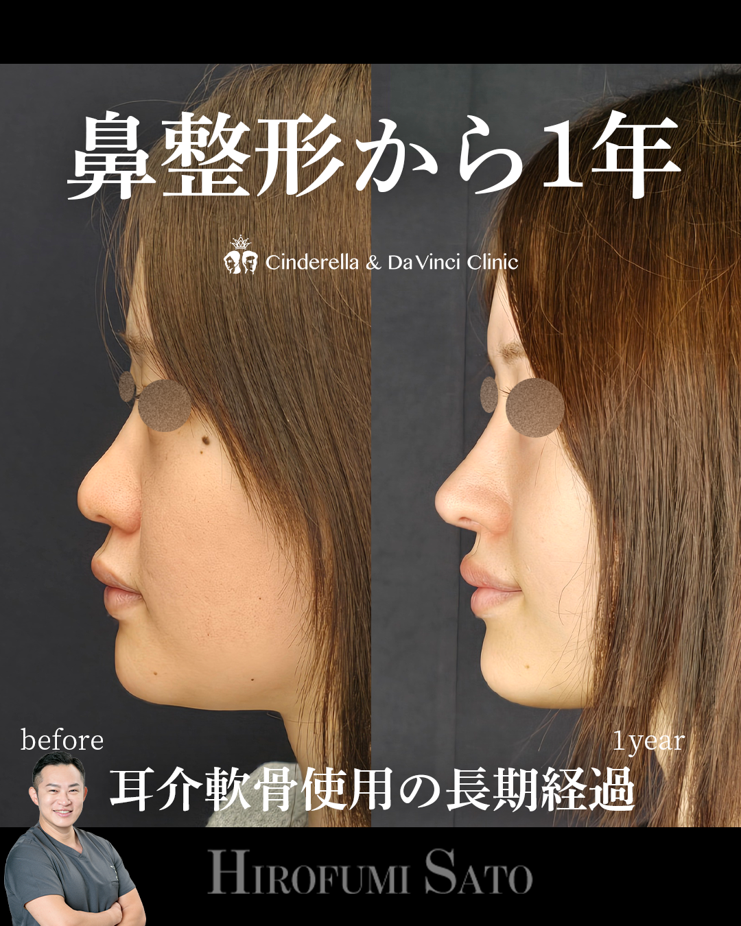 耳介軟骨の長期経過