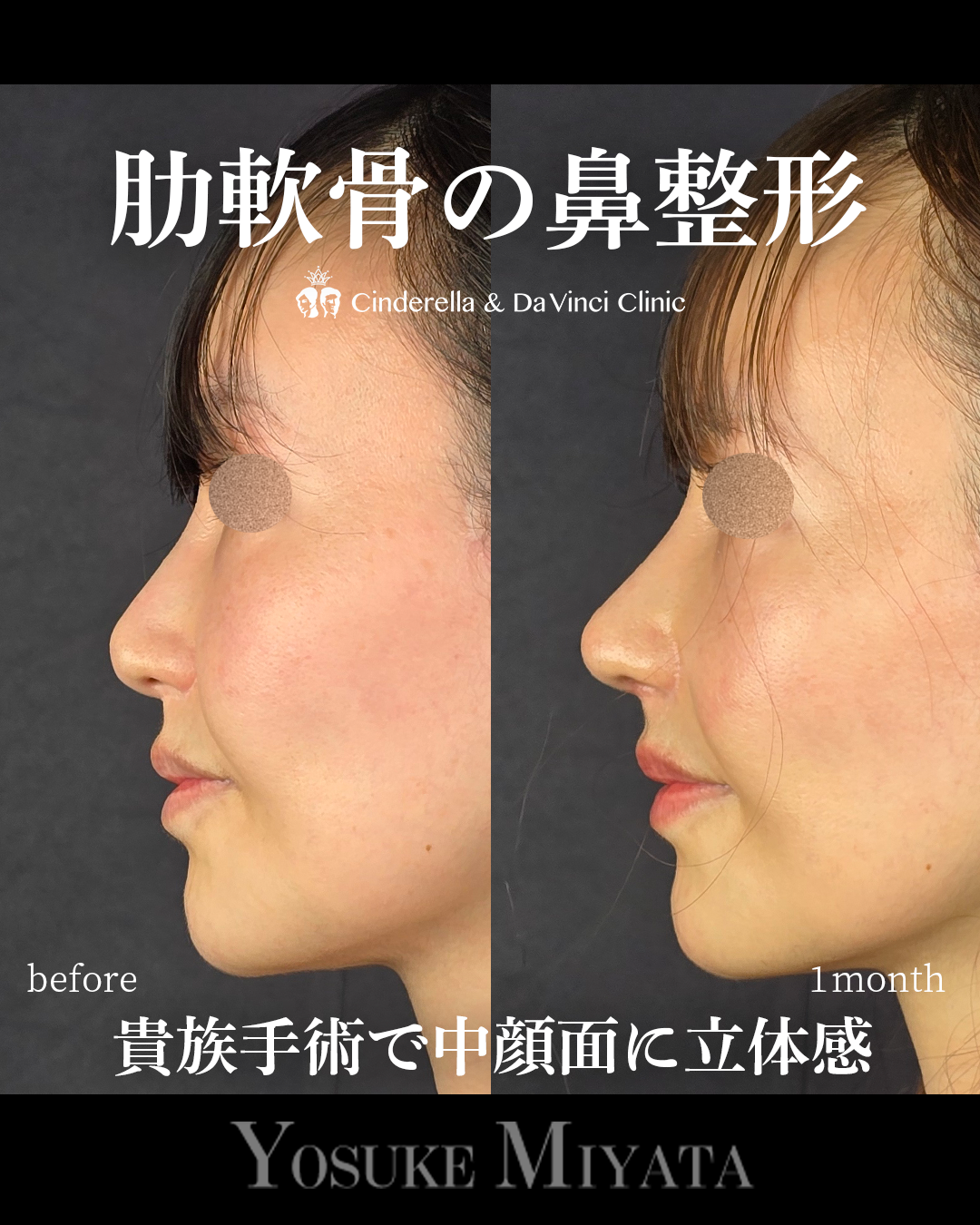 肋軟骨で他院修正