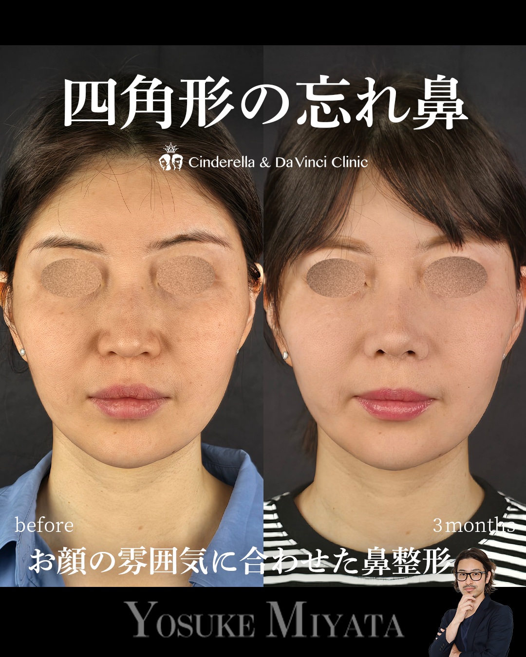 お顔の雰囲気に合わせた鼻整形の画像