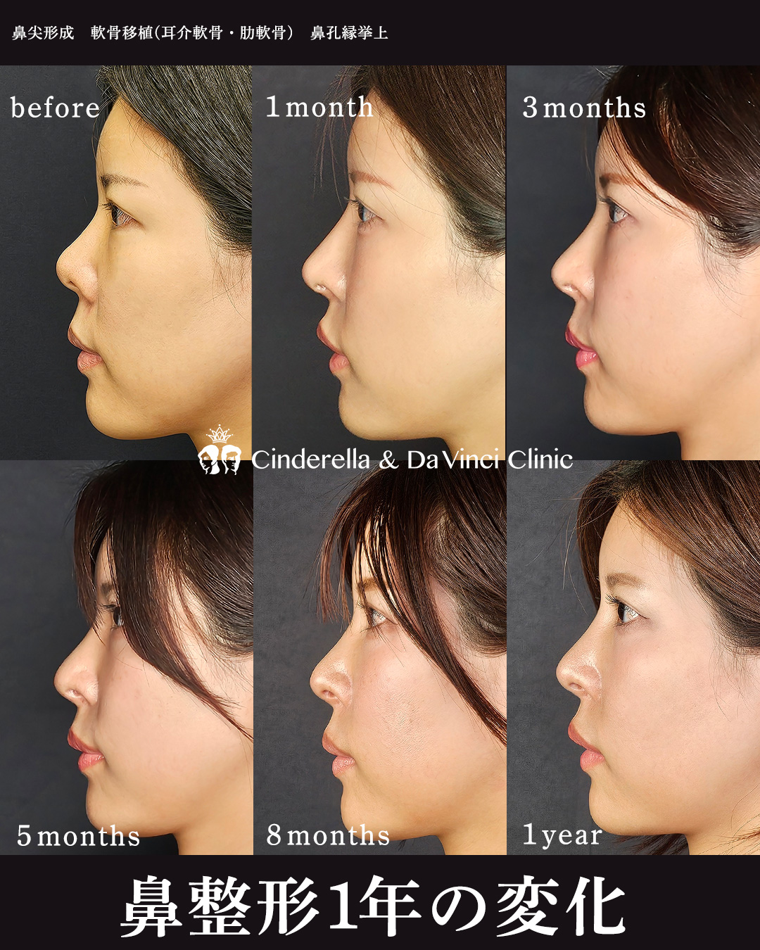 肋軟骨使用の手術から1年の画像
