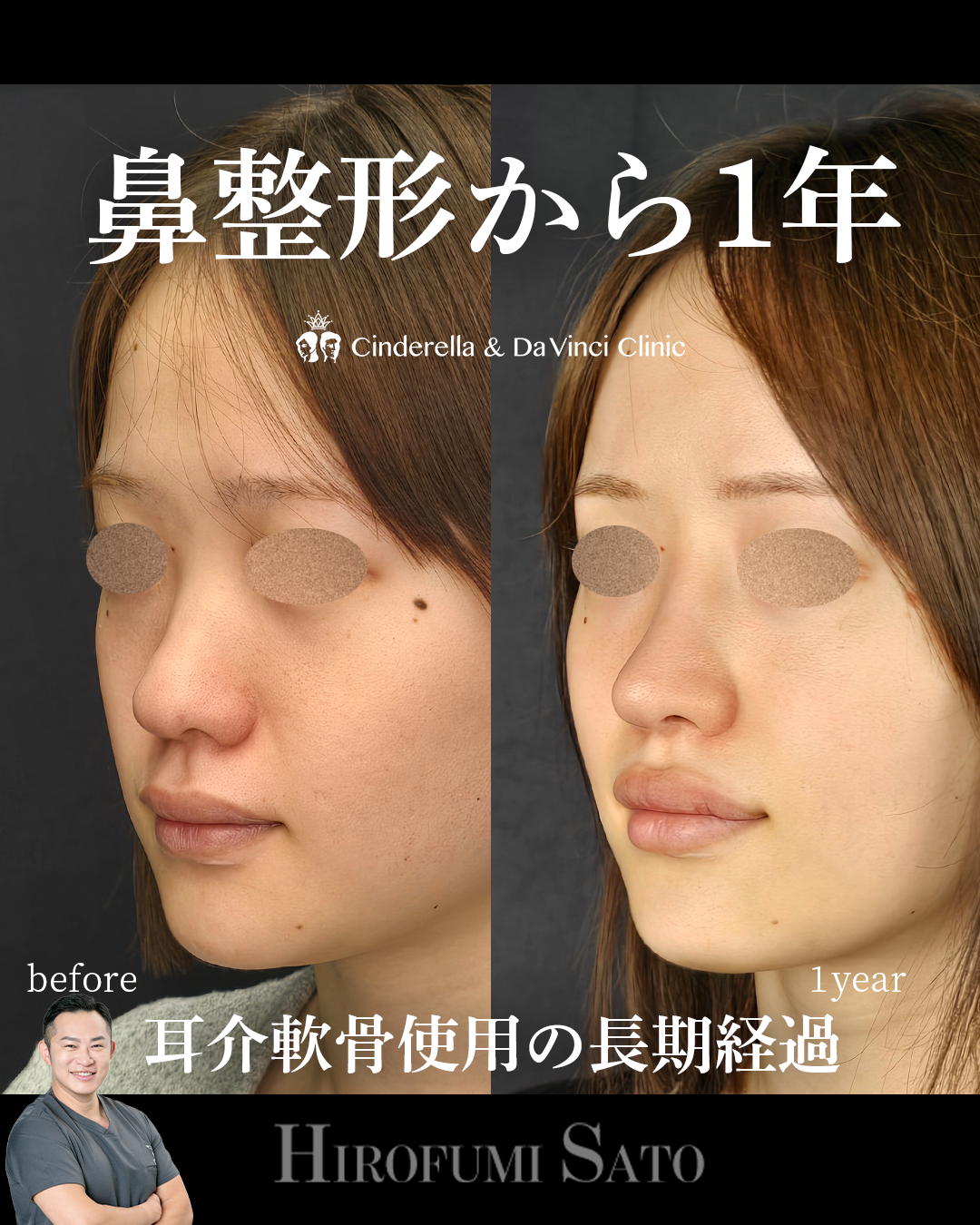 耳介軟骨の長期経過の画像