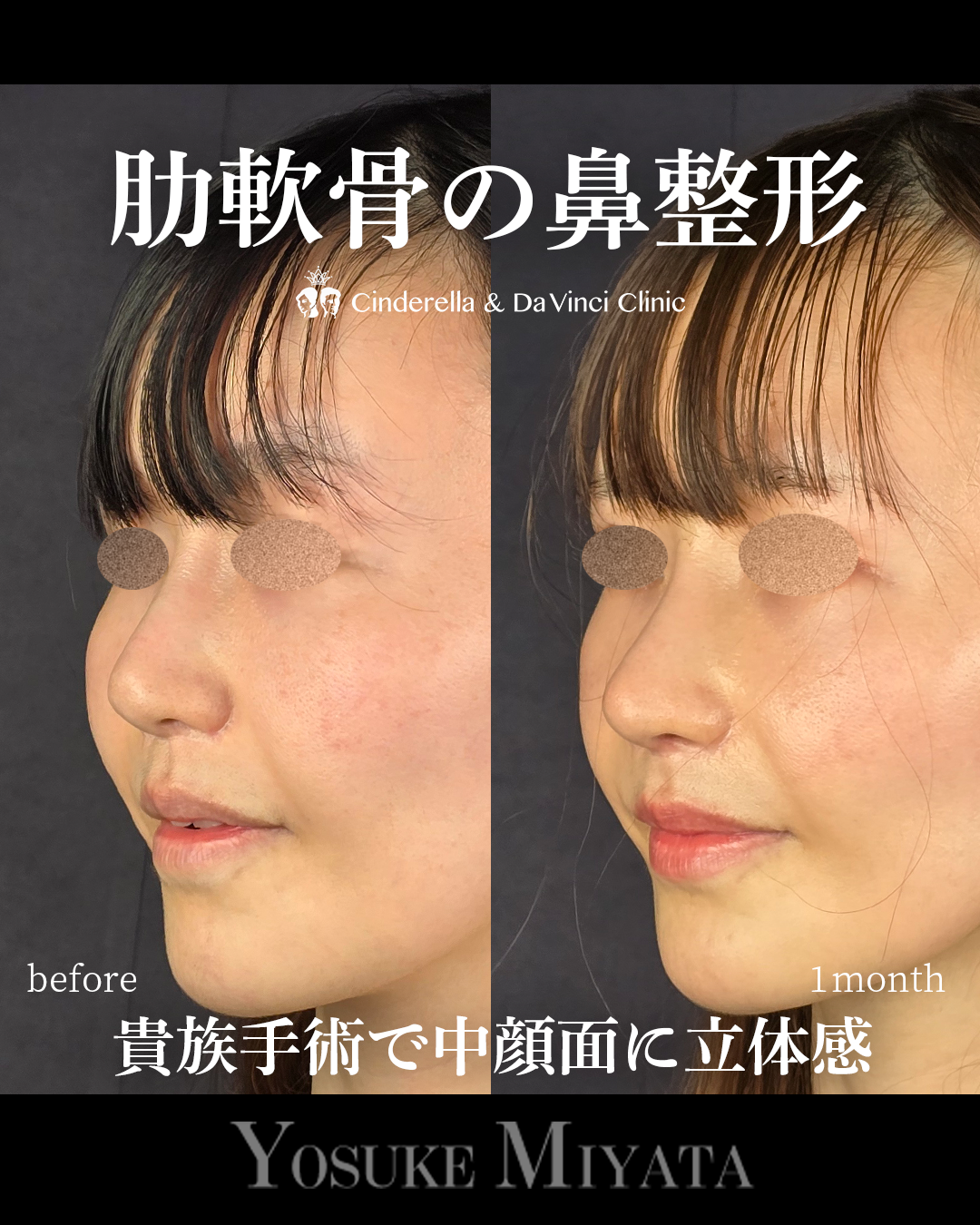 肋軟骨で他院修正の画像