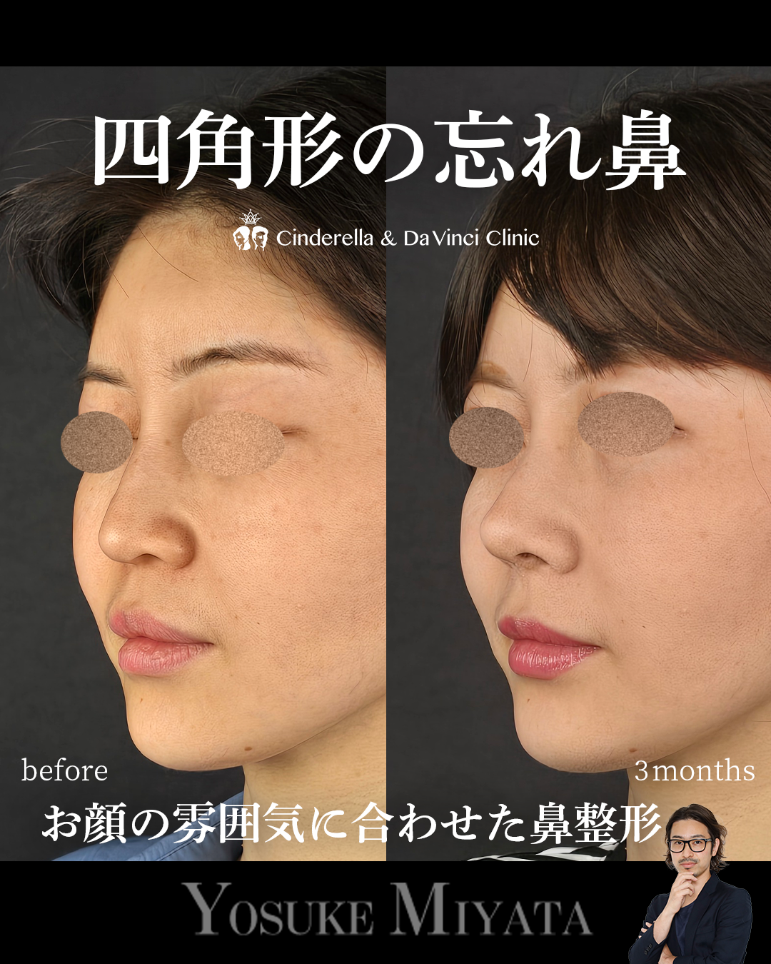 お顔の雰囲気に合わせた鼻整形の画像