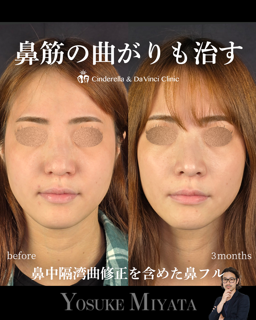 鼻中隔湾曲修正の画像