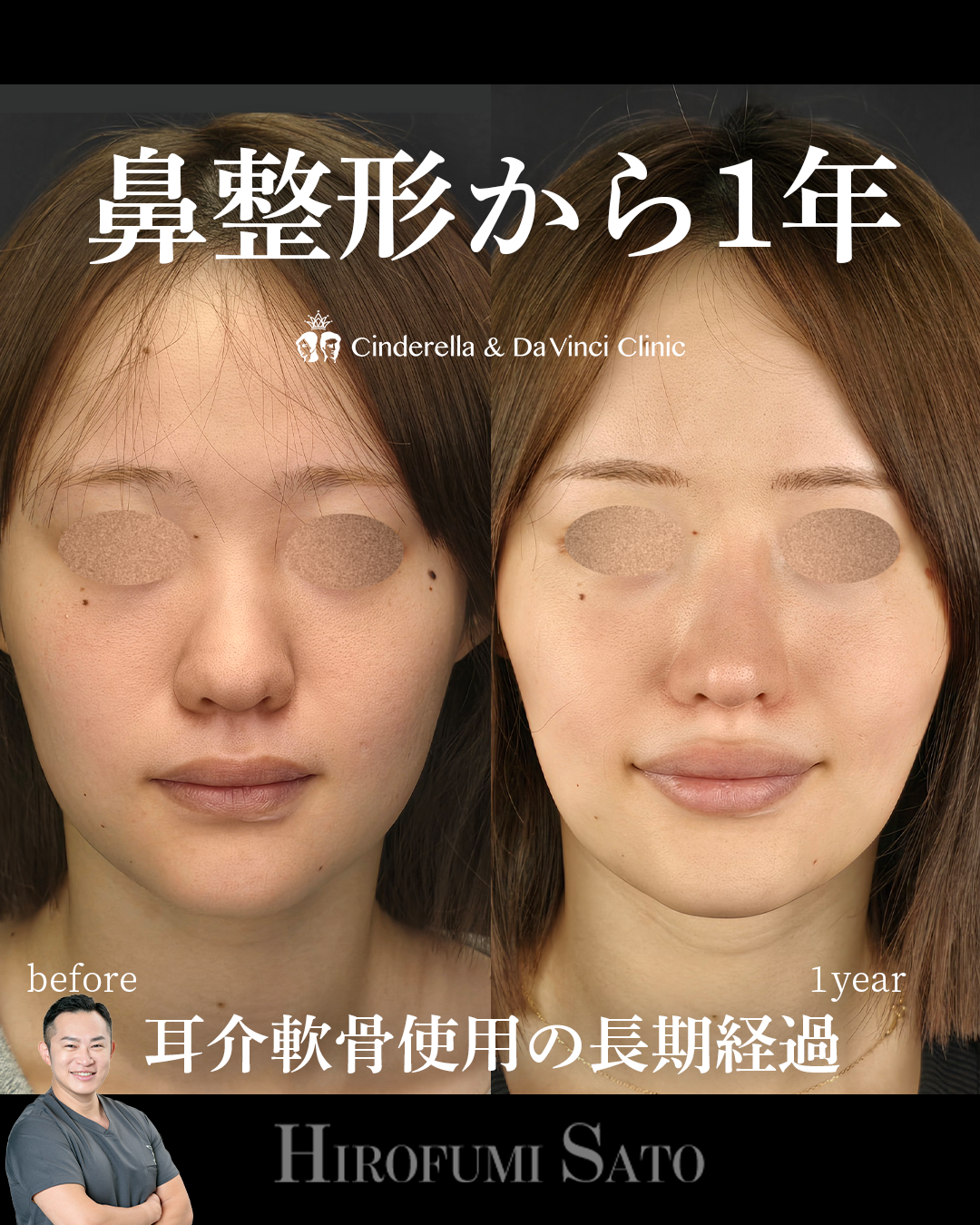 耳介軟骨の長期経過の画像
