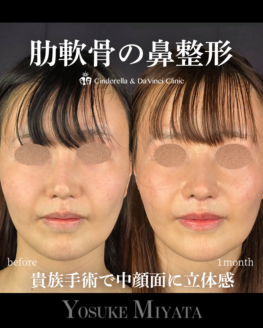 肋軟骨で他院修正の画像