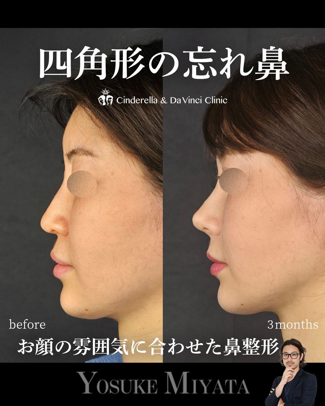 お顔の雰囲気に合わせた鼻整形の画像