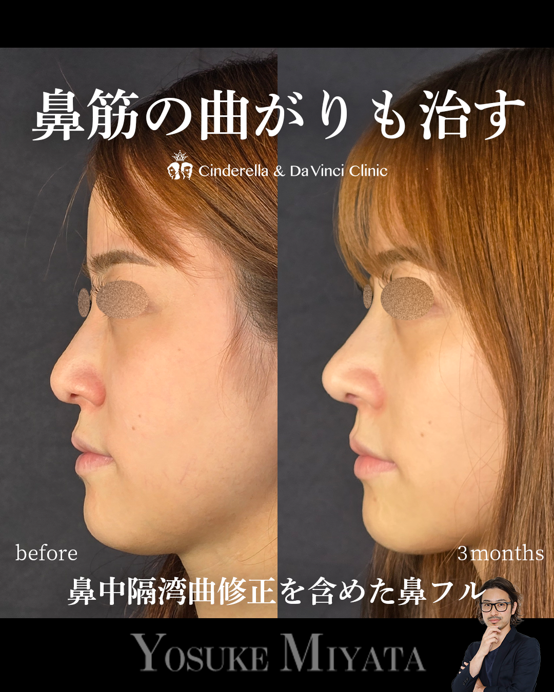 鼻中隔湾曲修正の画像