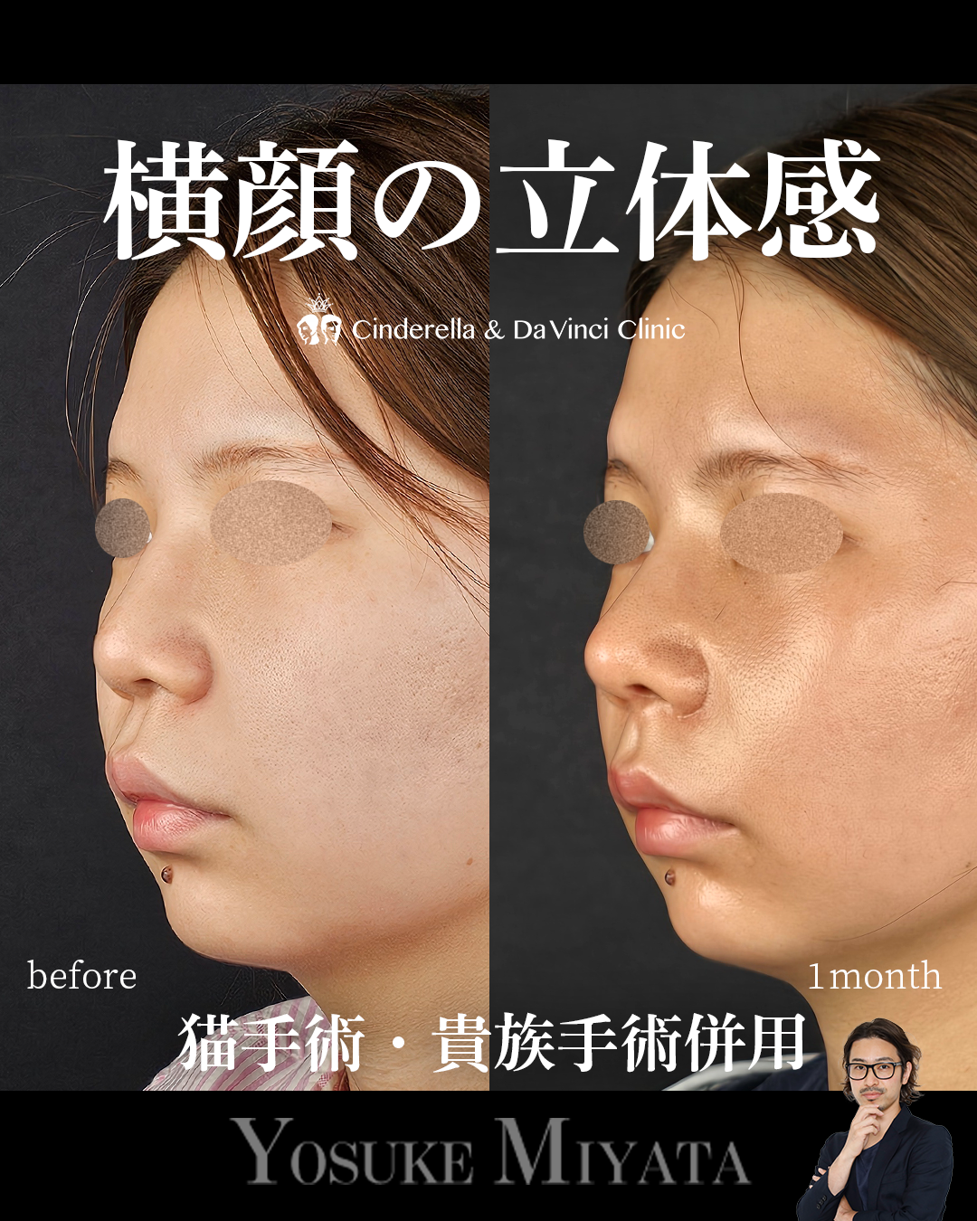だんご鼻を自然に整えるの画像