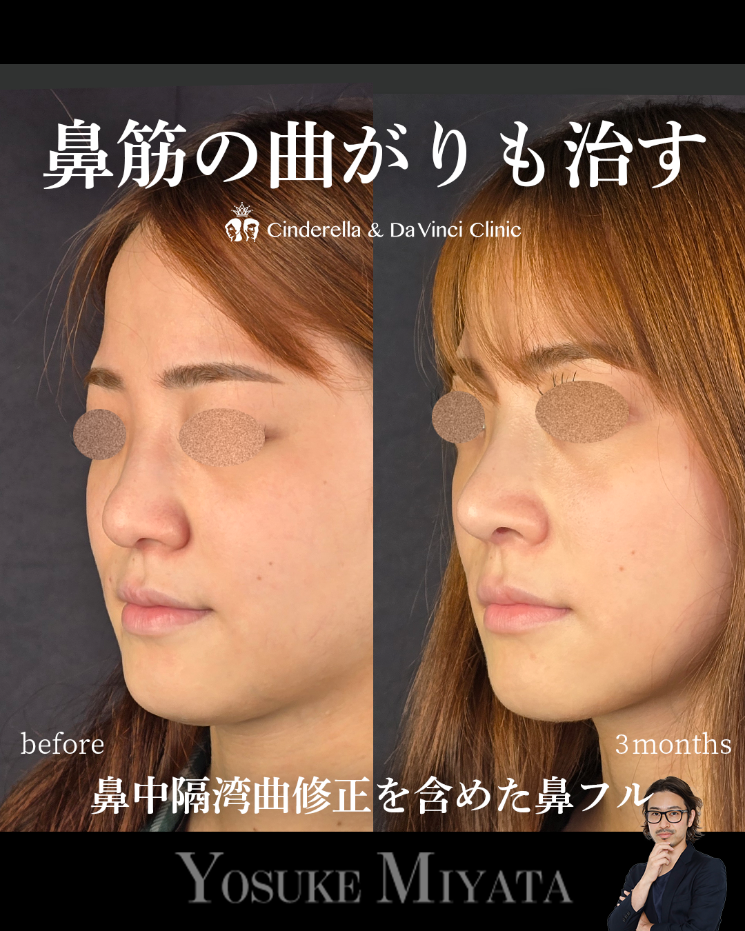 鼻中隔湾曲修正の画像