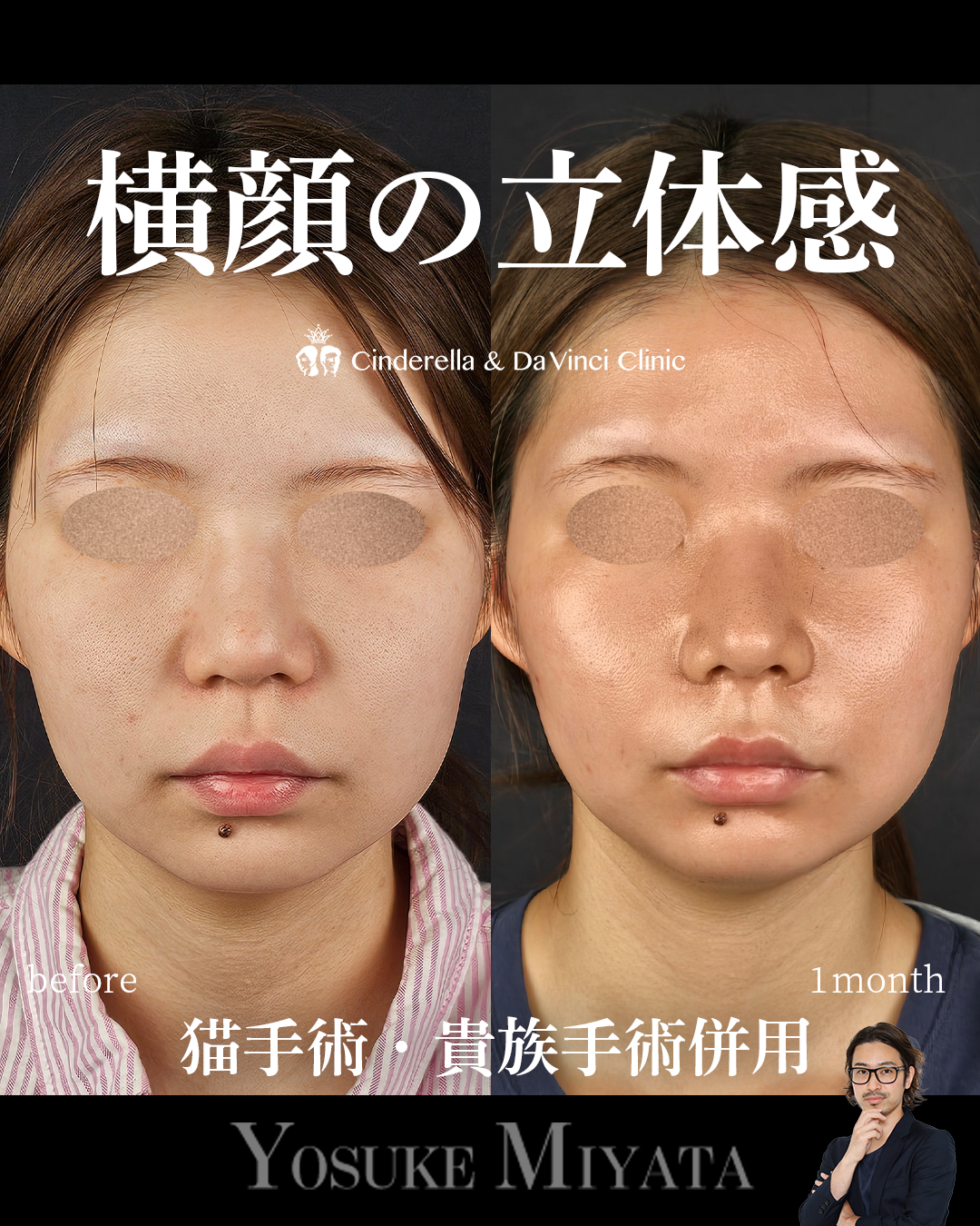 だんご鼻を自然に整えるの画像