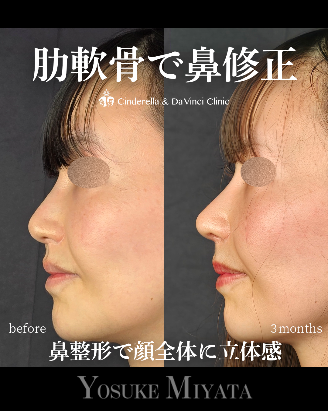 肋軟骨で他院修正の画像