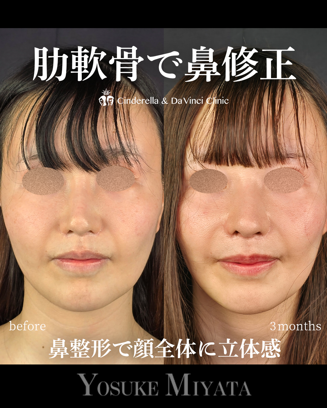 肋軟骨で他院修正の画像