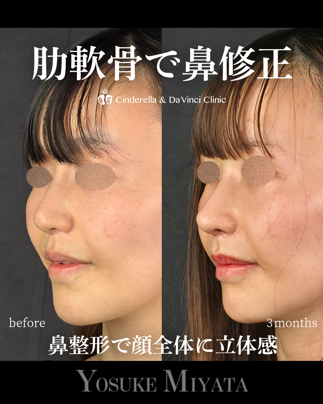 肋軟骨で他院修正の画像
