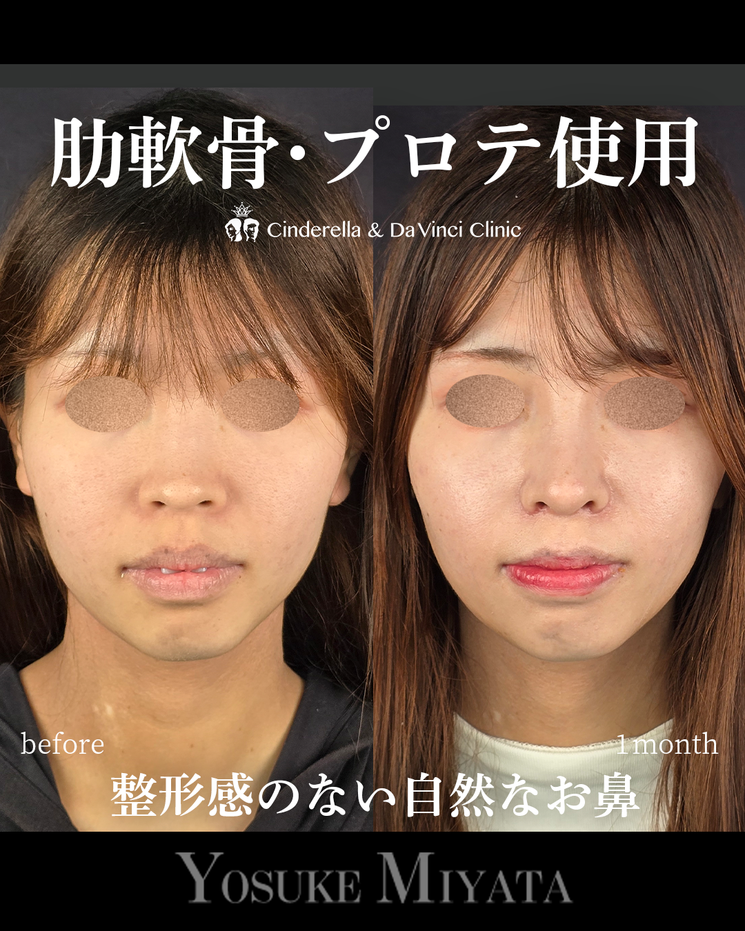 整形感なしの鼻整形の画像