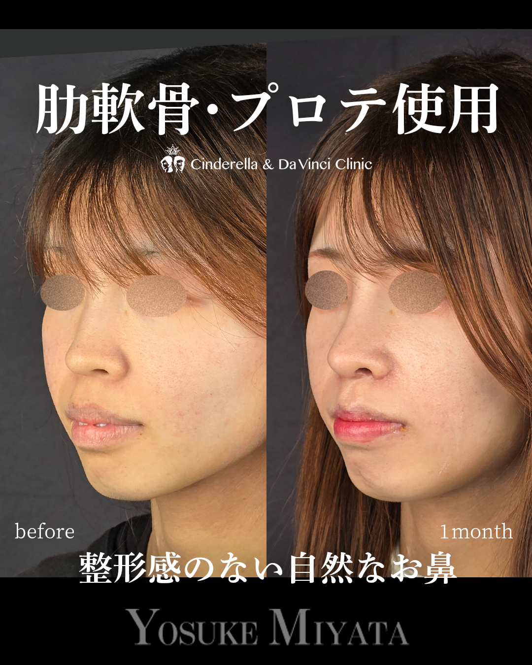 整形感なしの鼻整形の画像