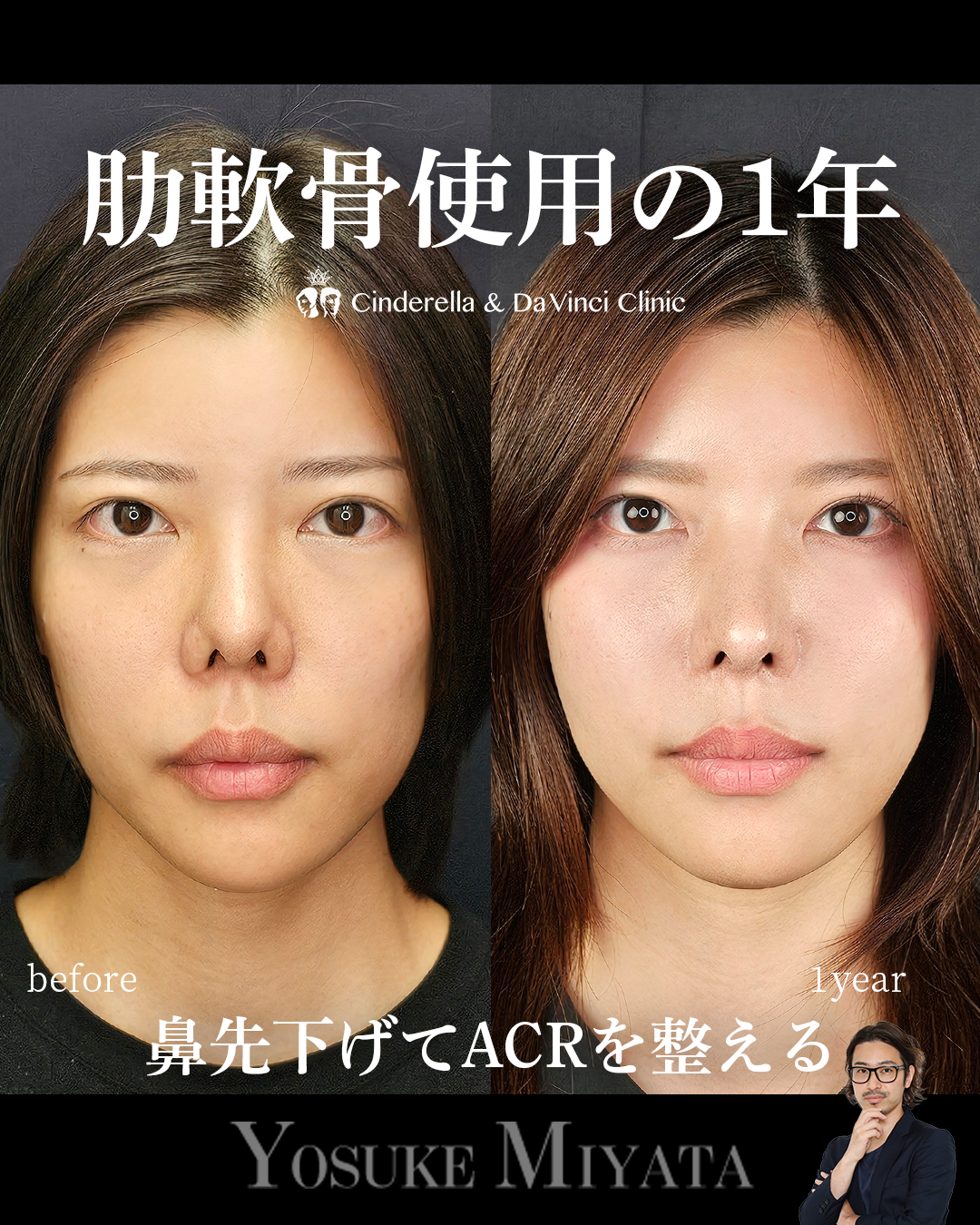 肋軟骨使用の手術から1年