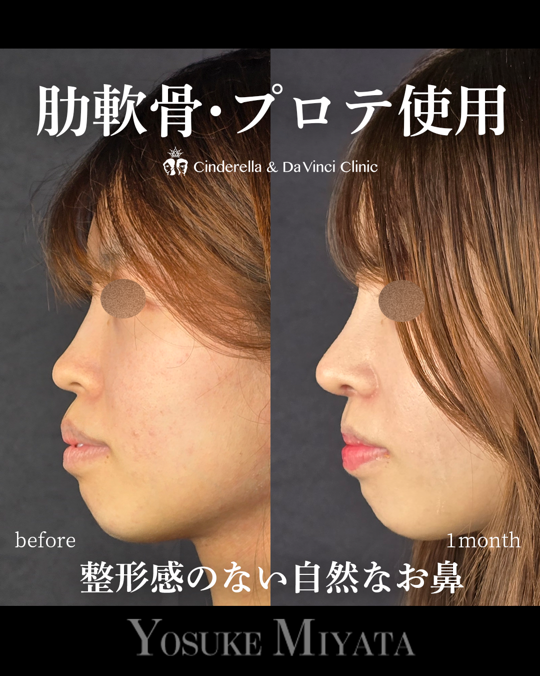 整形感なしの鼻整形