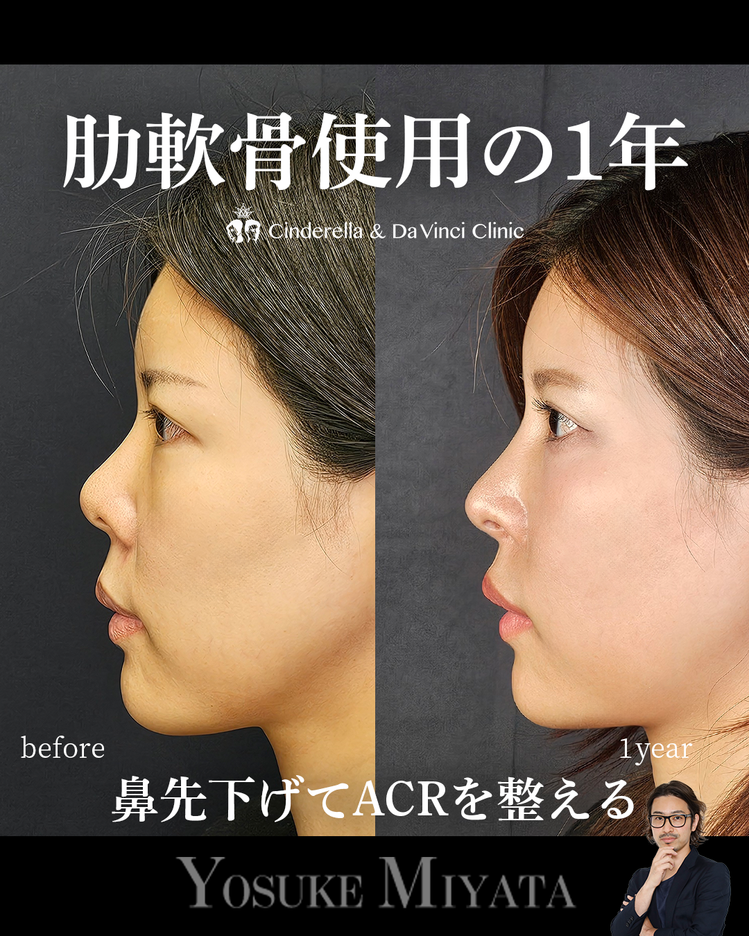 肋軟骨使用の手術から1年の画像