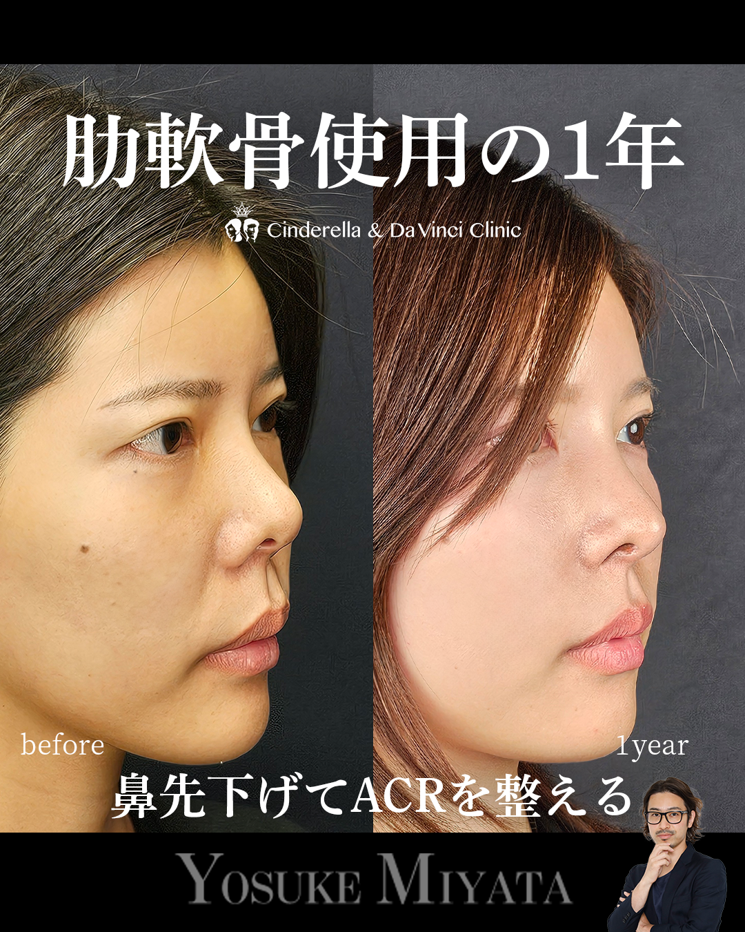 肋軟骨使用の手術から1年の画像
