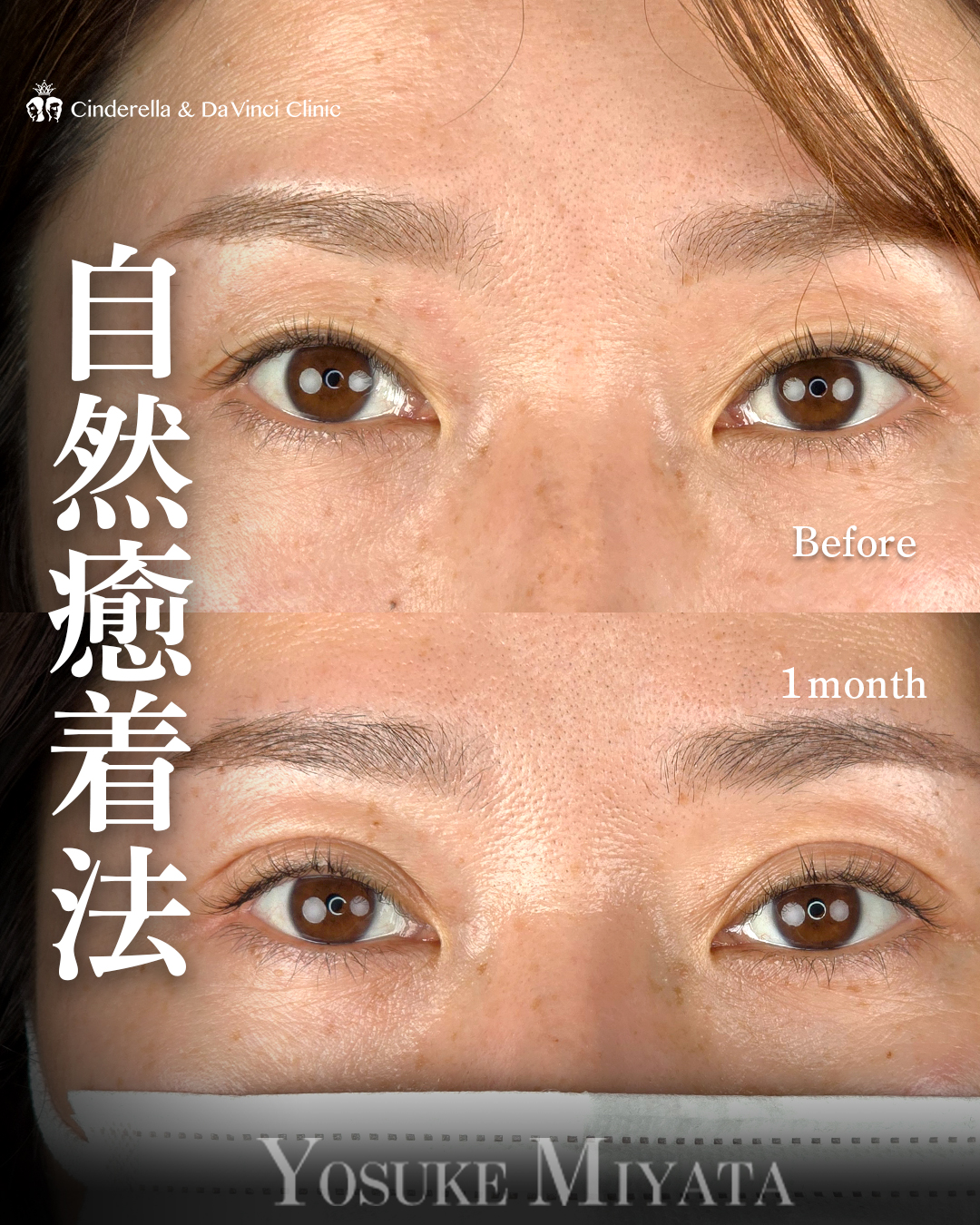 埋没で広めの平行二重
