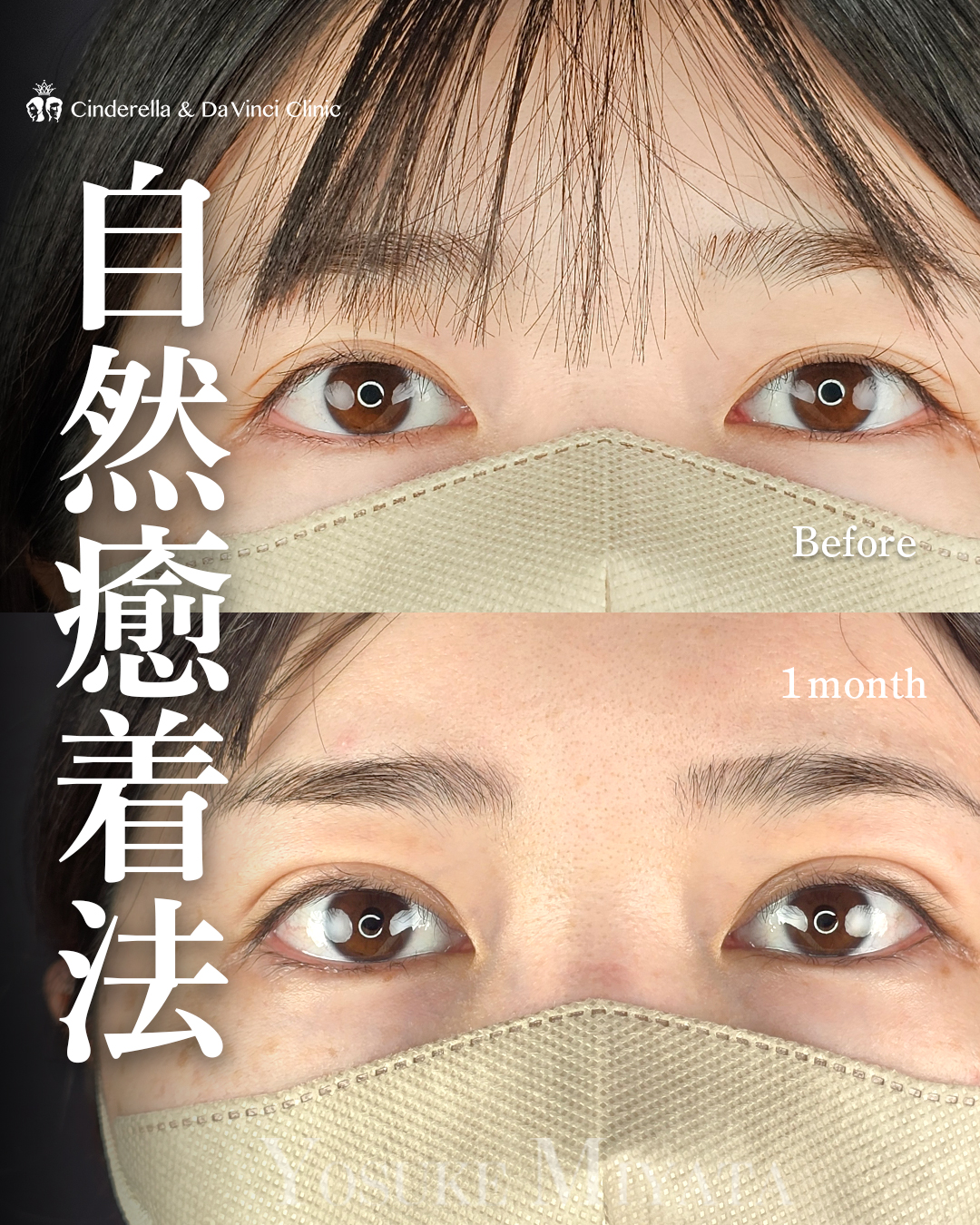 自然癒着法で幅を広げる