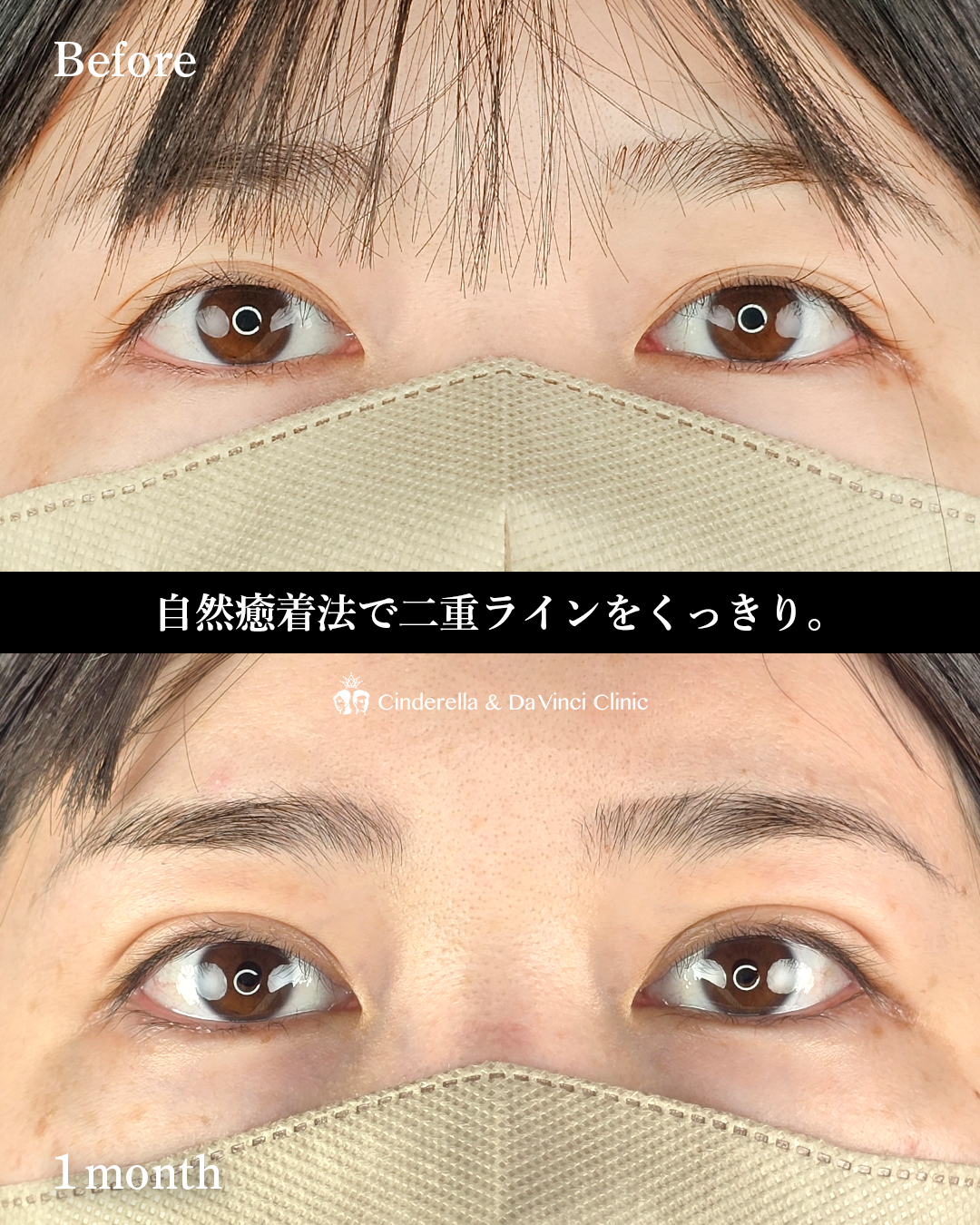 自然癒着法で幅を広げるの画像