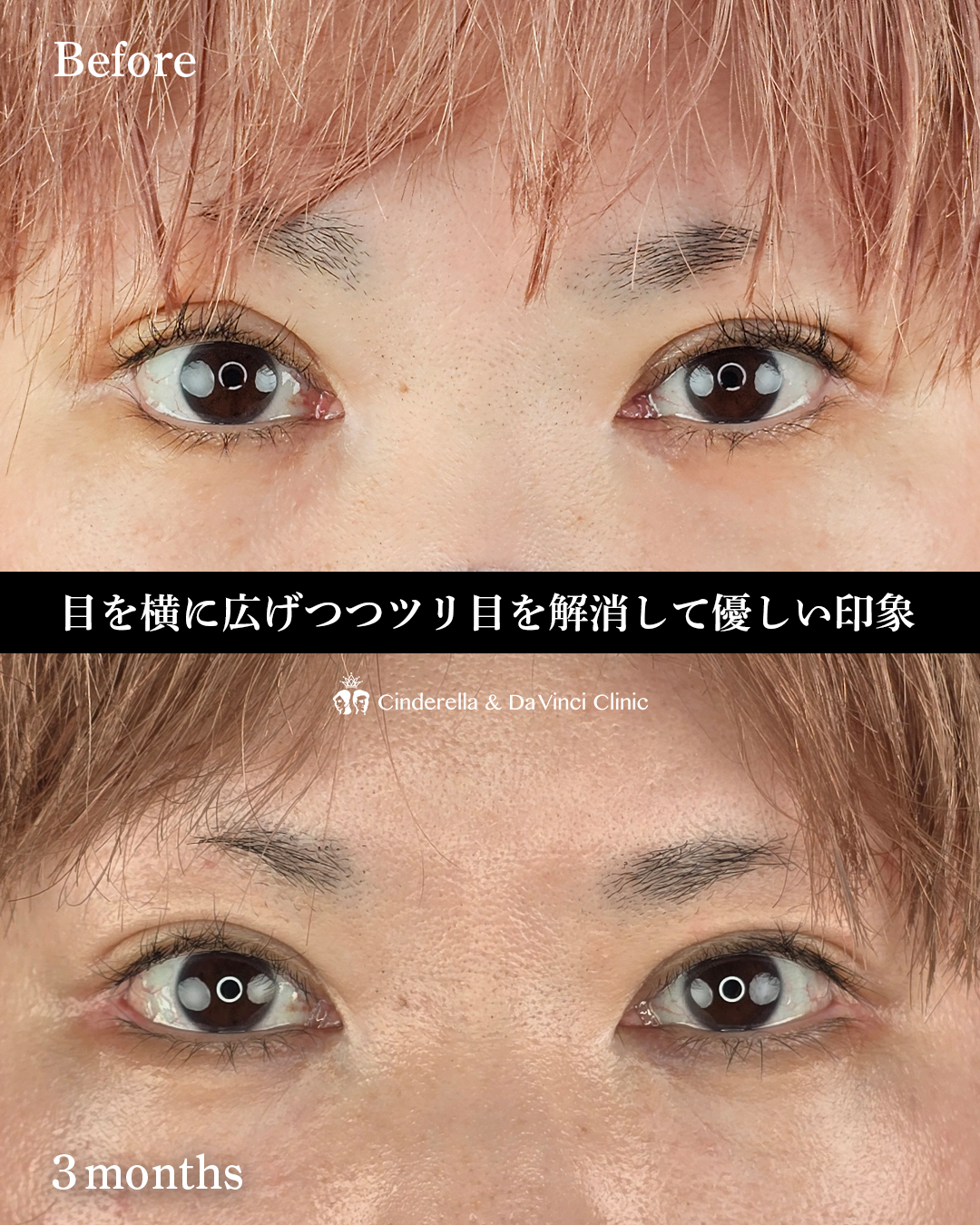 目を横に広げるの画像
