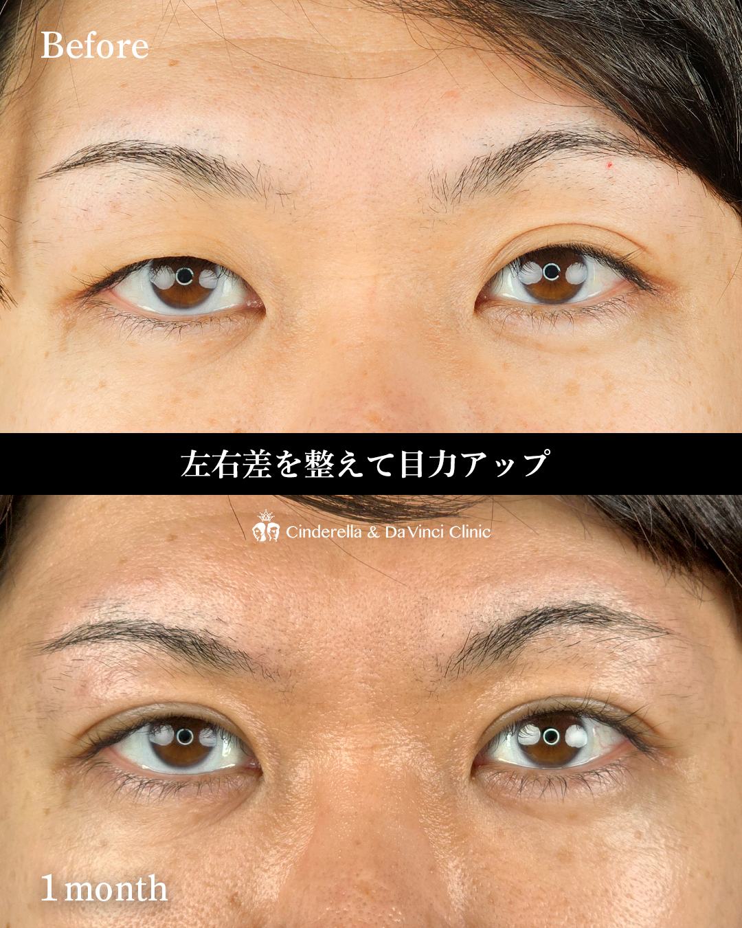 目の左右差改善の画像