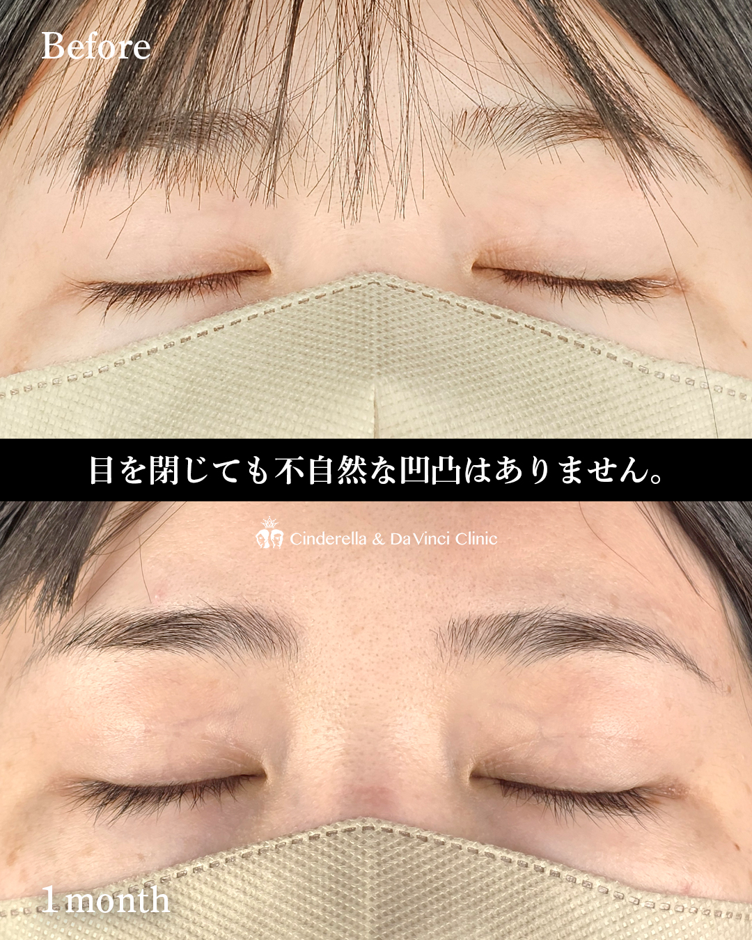 自然癒着法で幅を広げるの画像