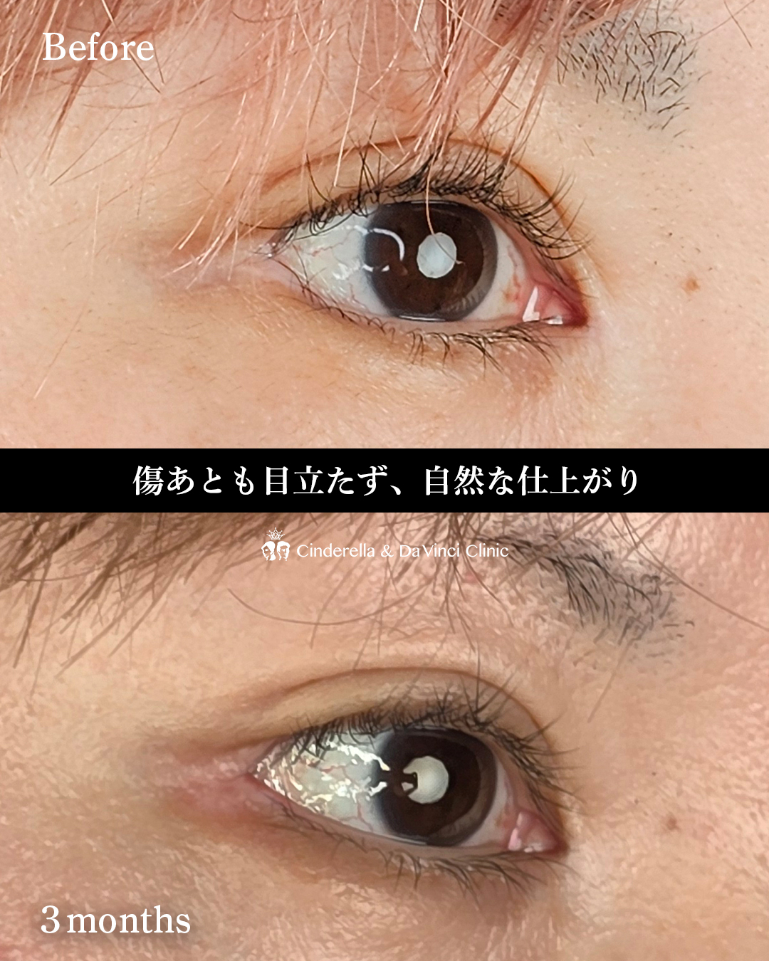 目を横に広げるの画像