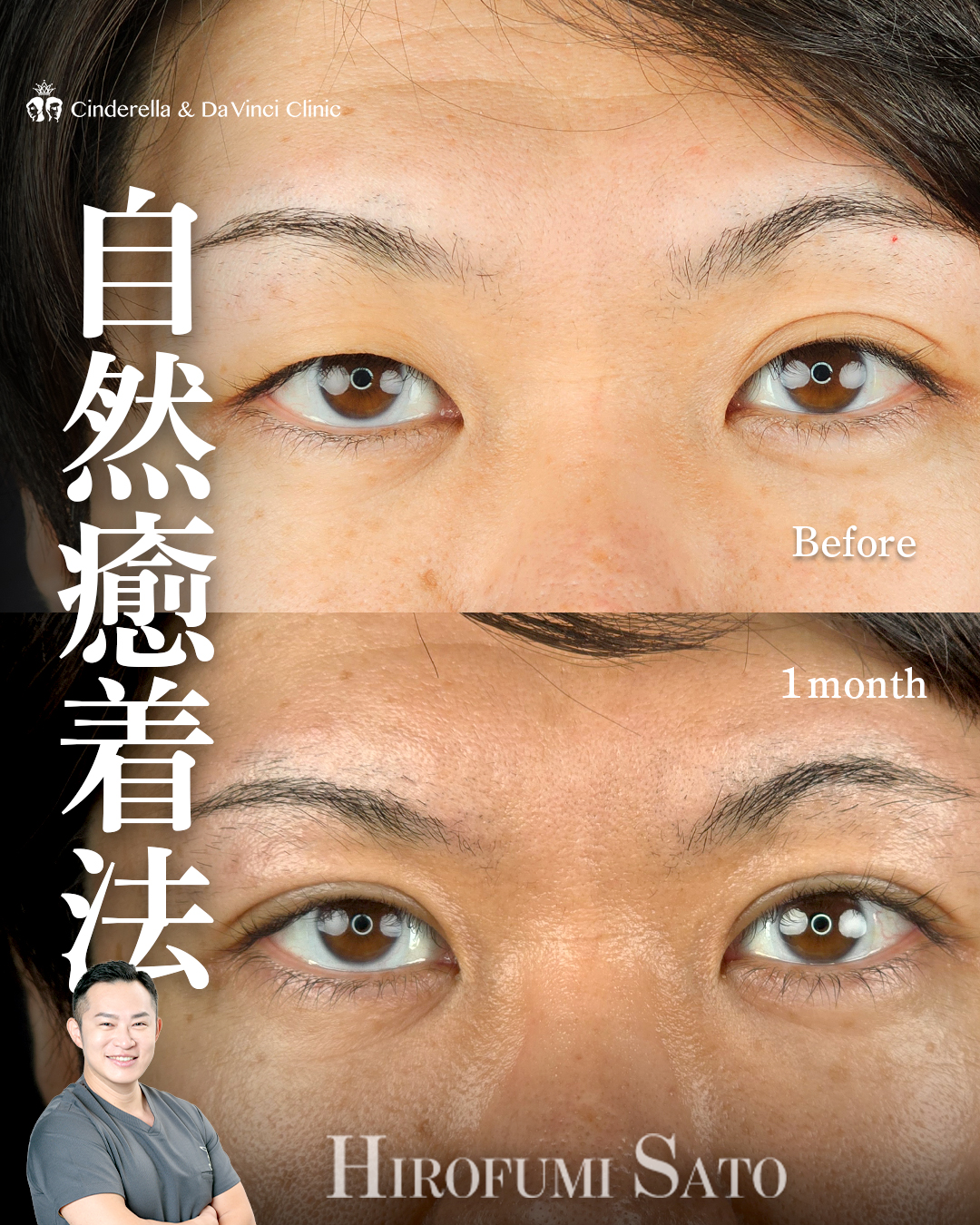目の左右差改善
