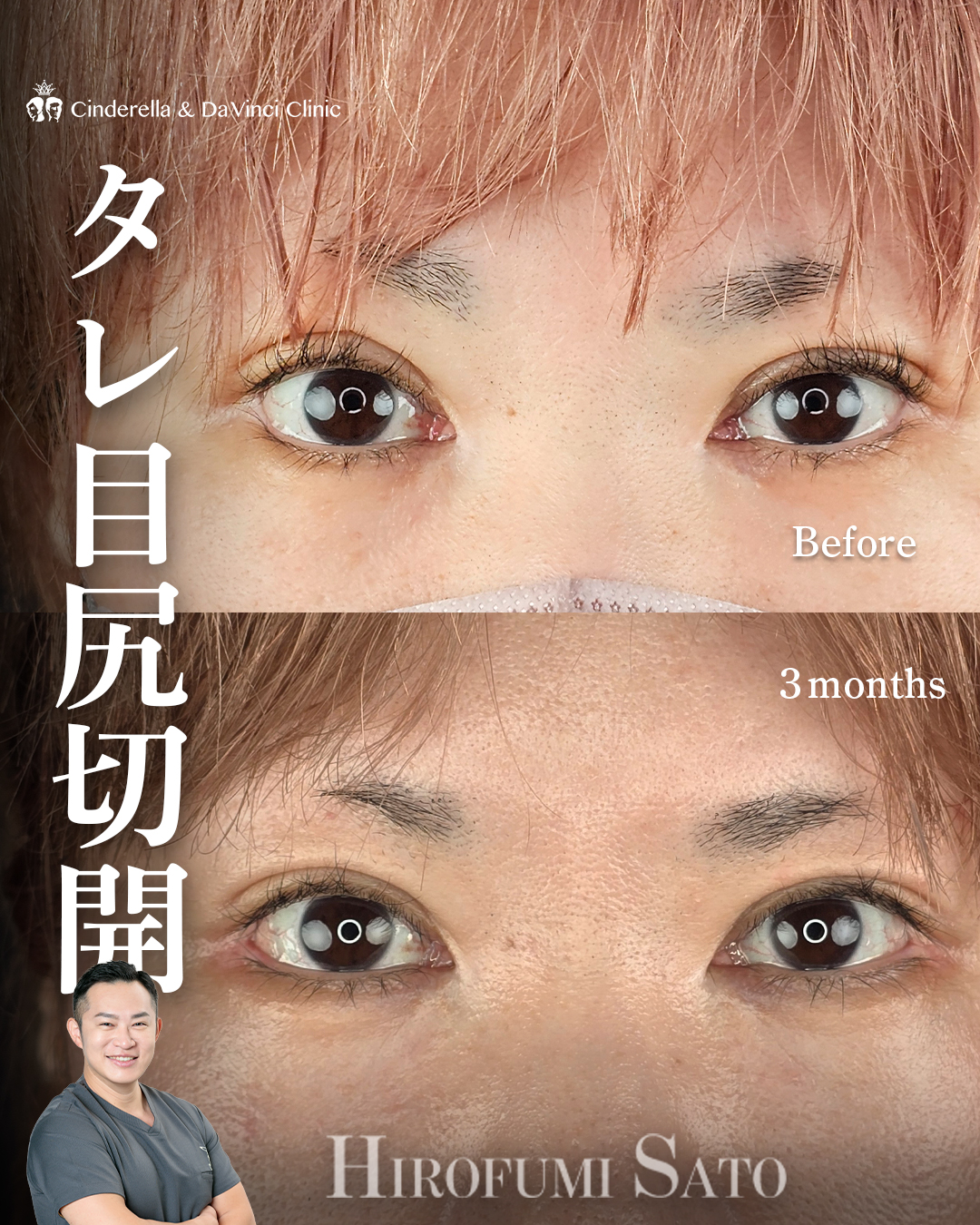 目を横に広げる