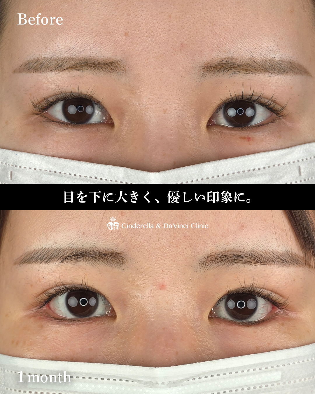 タレ目手術と目尻切開同時の画像