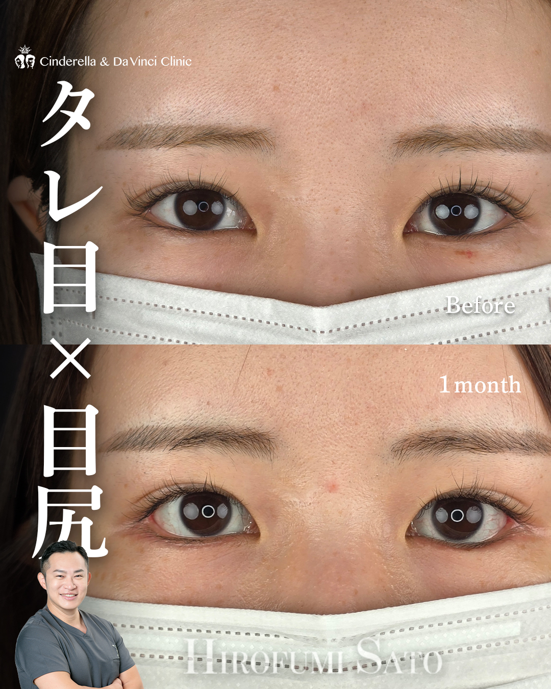 タレ目手術と目尻切開同時