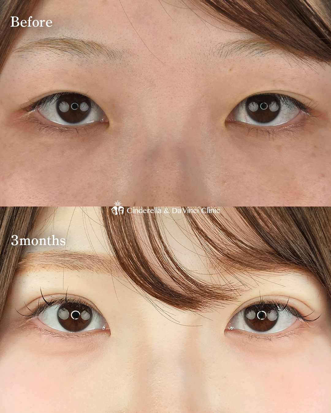 二重切開でミックス型の画像