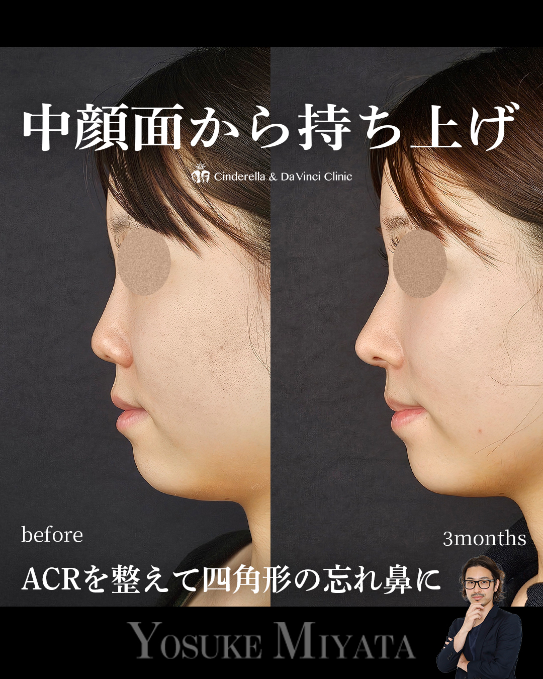 中顔面から高さを出すの画像