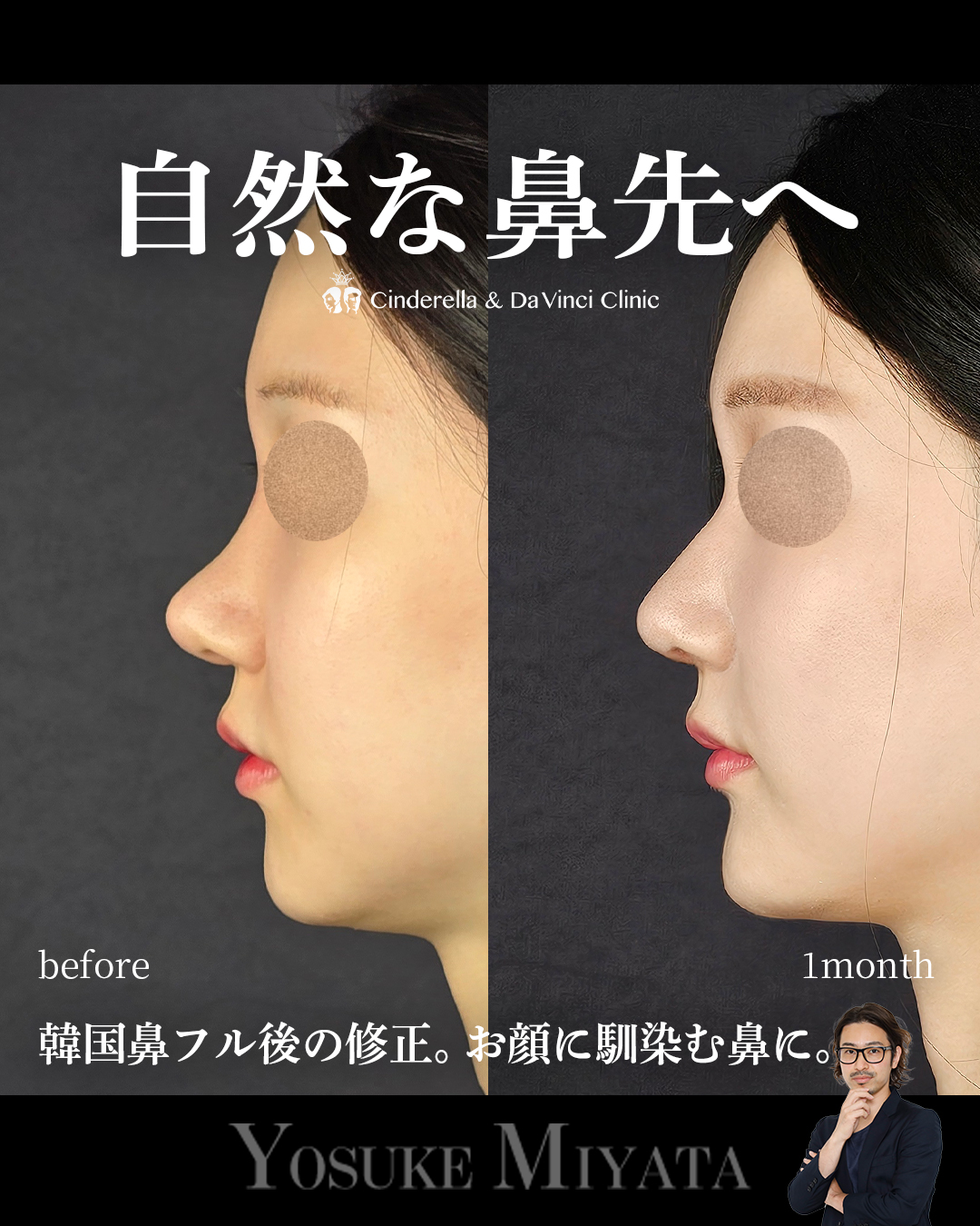自然な鼻先へ