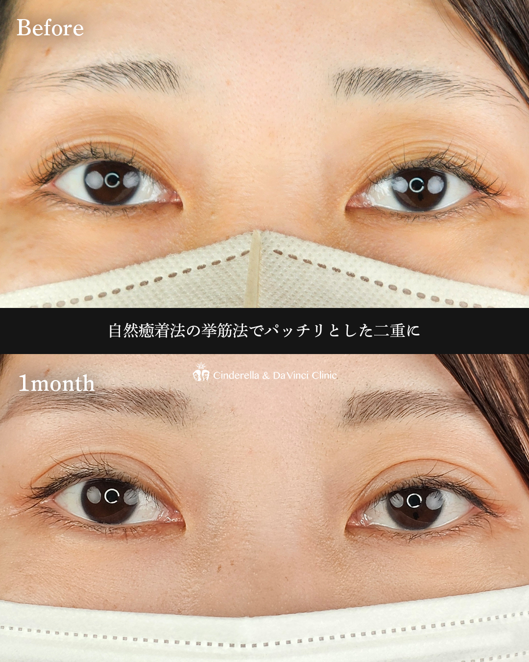 ぱっちり二重の画像